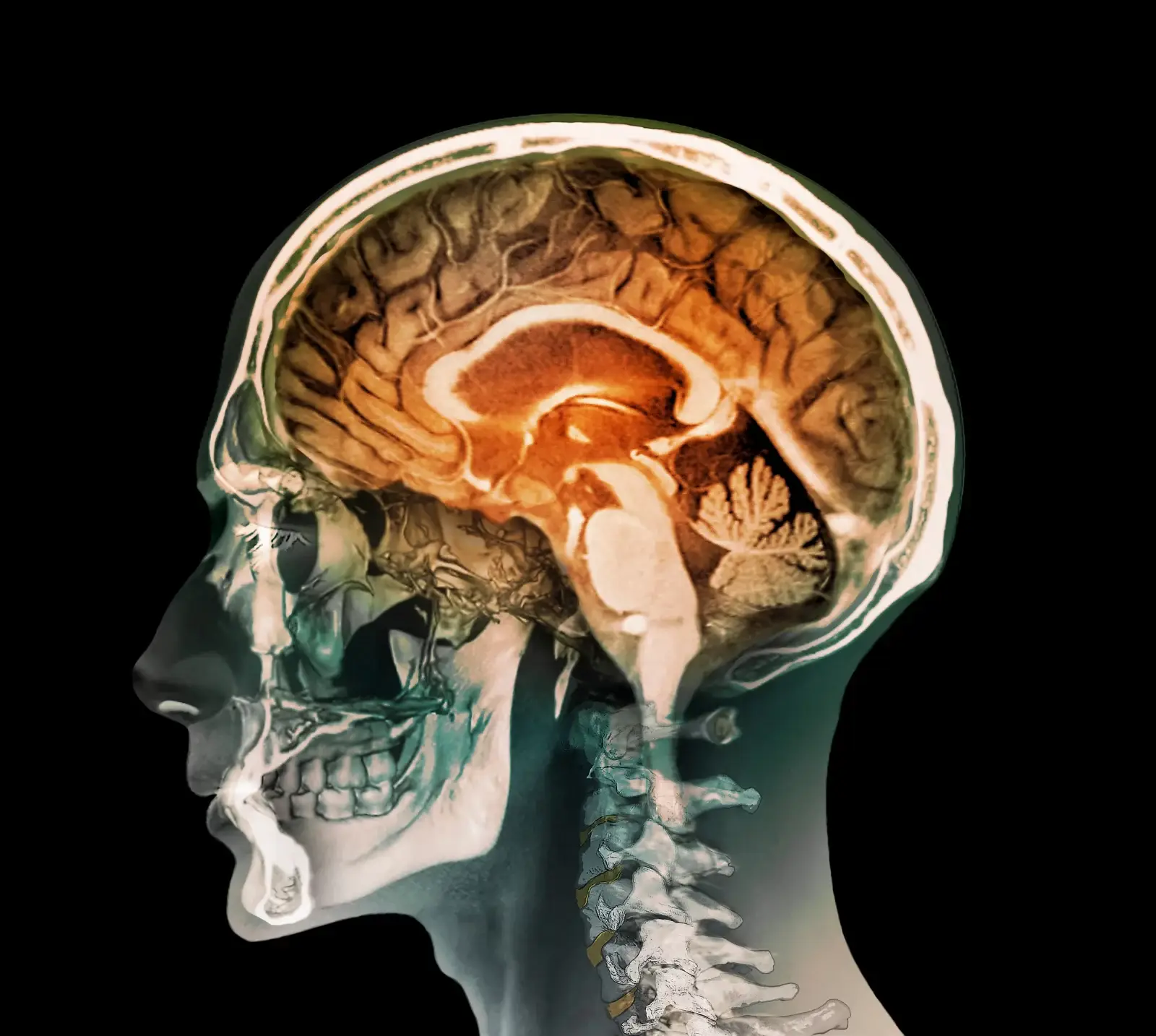 Brain scan highlighting injury, representing traumatic brain injury legal claims.