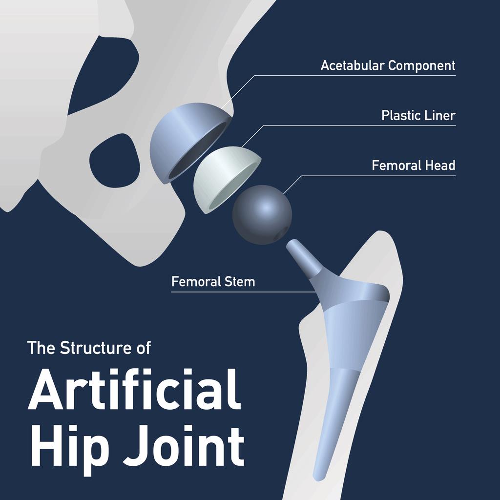 depuy hip replacement image