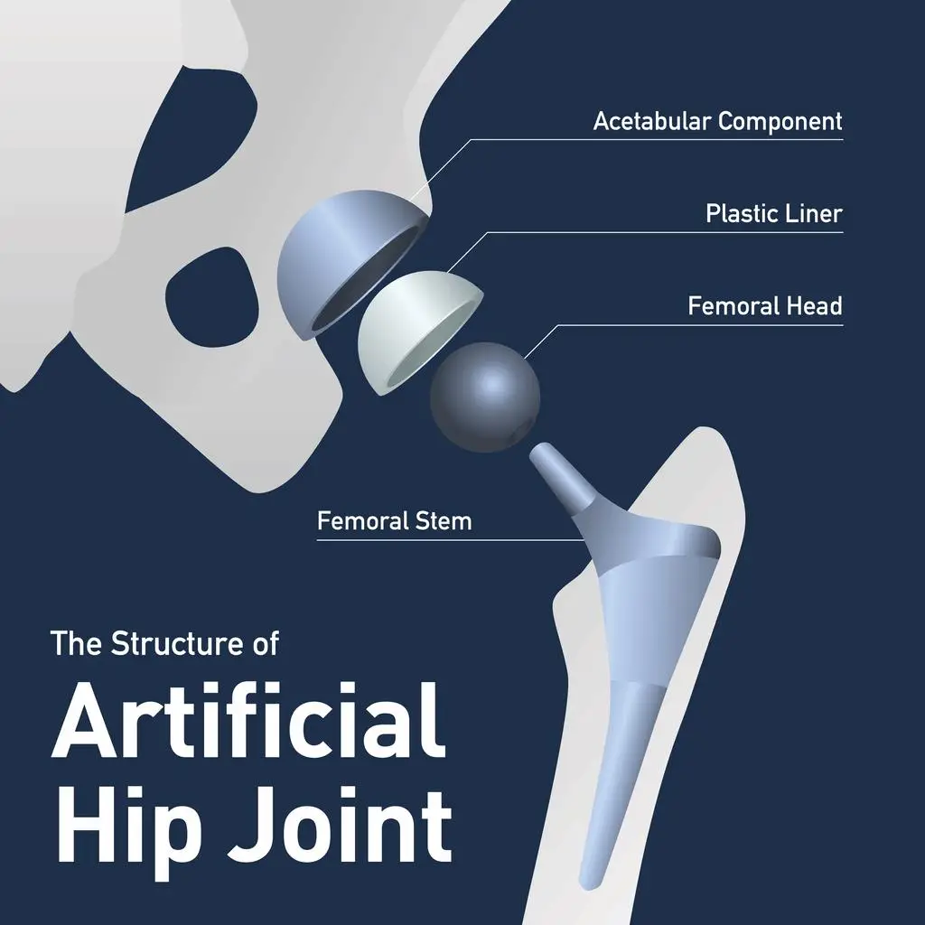 Diagram of an artificial hip joint structure, featuring labeled components including acetabular component, plastic liner, femoral head, and femoral stem, relevant to hip replacement discussions.