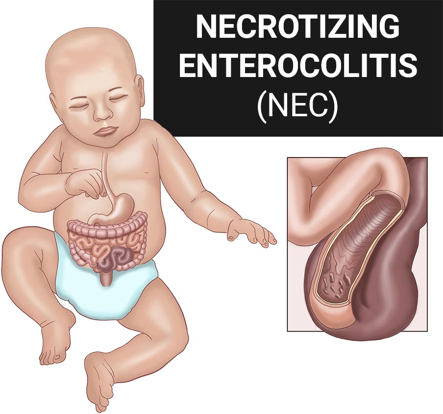necrotizing enterocolitis lawsuit